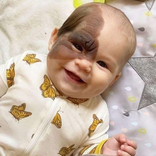 Parents’ Determination Helps Young Daughter Undergo Birthmark Removal Surgery